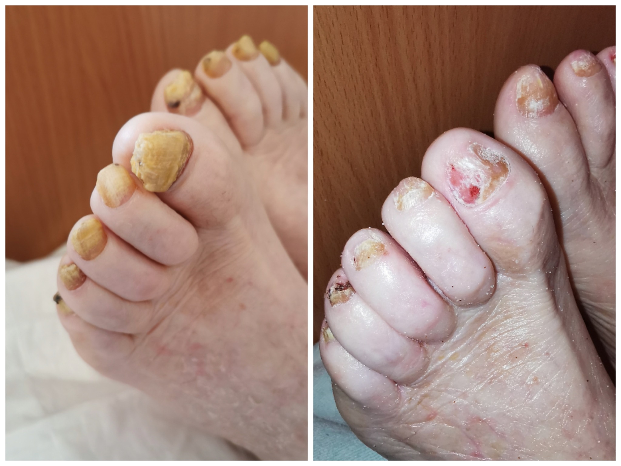 Porównanie stóp przed i po zabiegu na grzybicę paznokci, widoczne zmiany w wyglądzie paznokci i skóry.