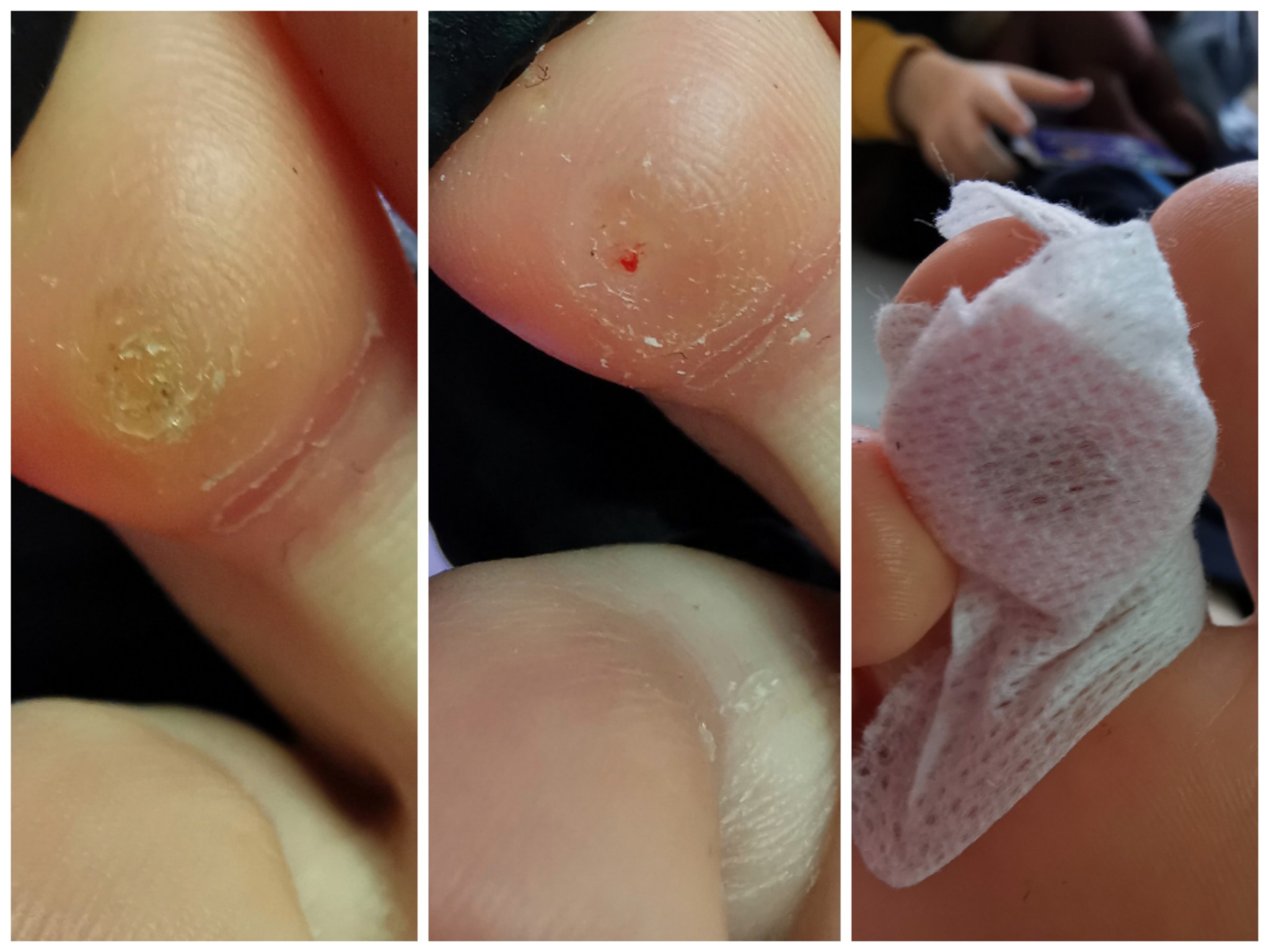 Zbliżenie na palce u stóp z widocznymi odciskami i raną po usunięciu, jeden z palców owinięty chusteczką higieniczną.