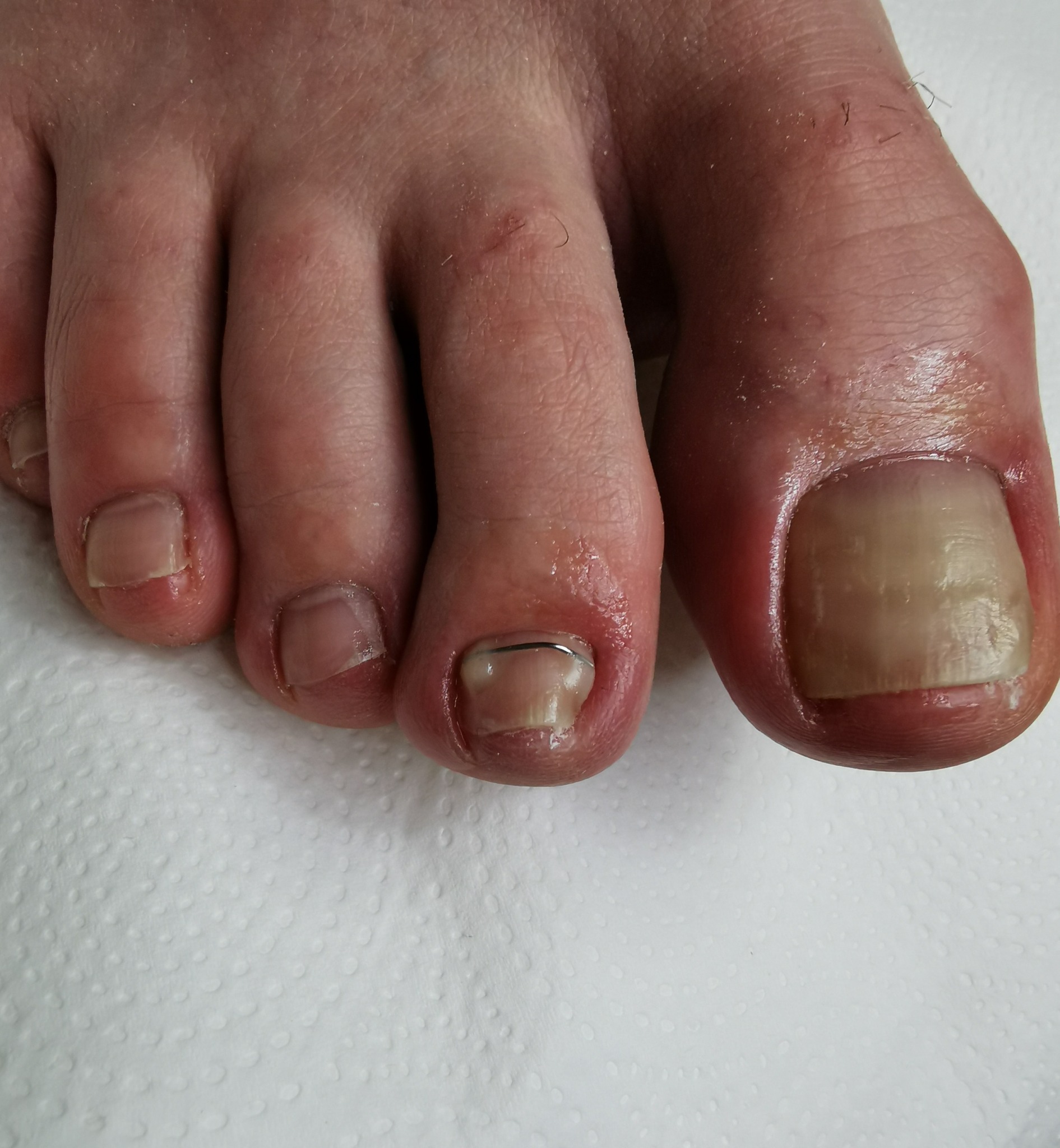 Przybliżenie stopy z widocznym wrastającym paznokciem, na którym założona jest metalowa klamra korekcyjna. Duży palec z widoczną onycholizą.