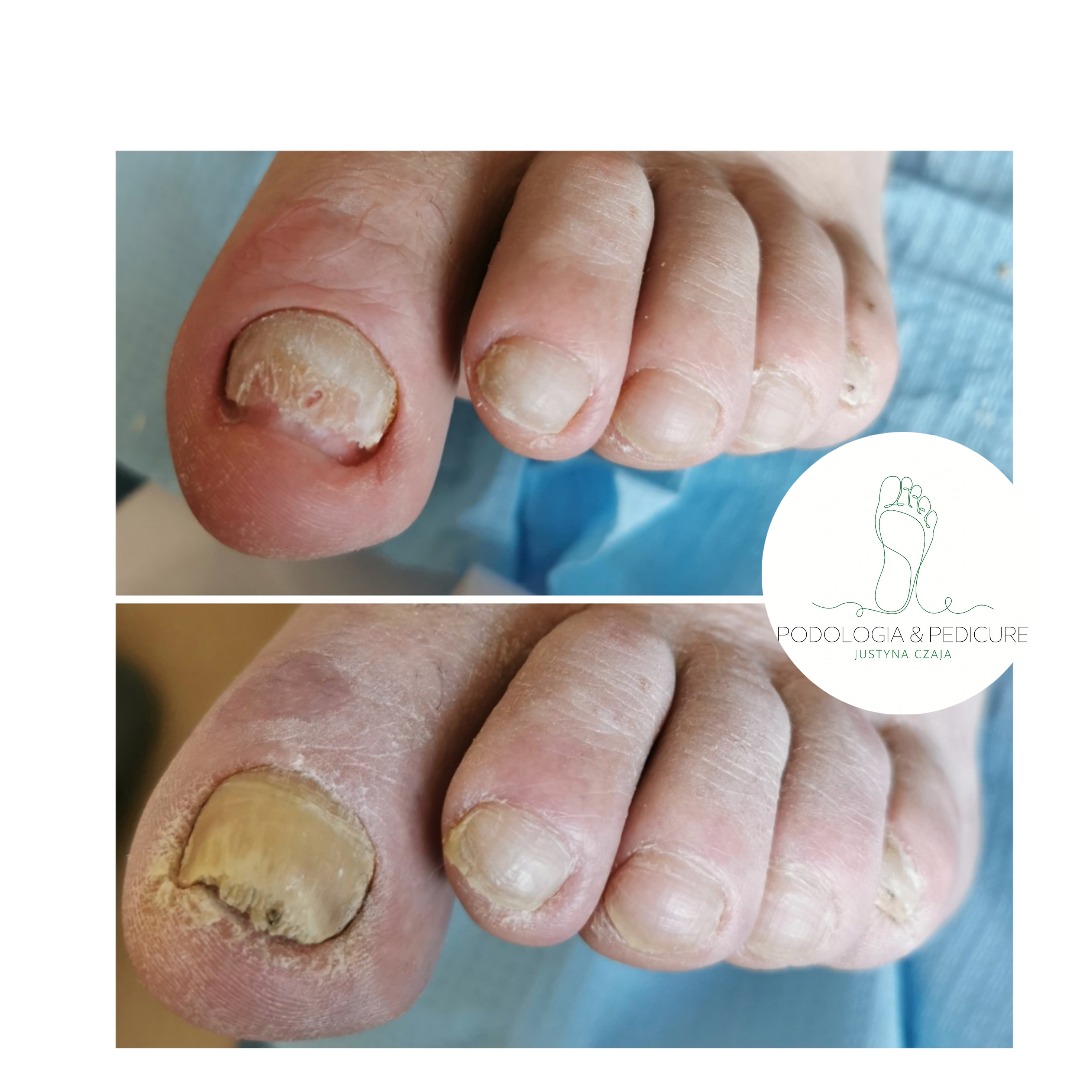 Bliskie ujęcie stóp z problemami grzybiczymi paznokci przed i po zabiegu w Gorzowie Wielkopolskim, z widocznym logo firmy podologicznej.