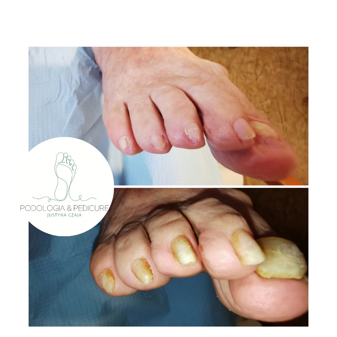 Stopa przed i po zabiegu podologicznym, widoczne zmiany chorobowe paznokci oraz logo gabinetu Podologia & Pedicure Justyna Czaja.