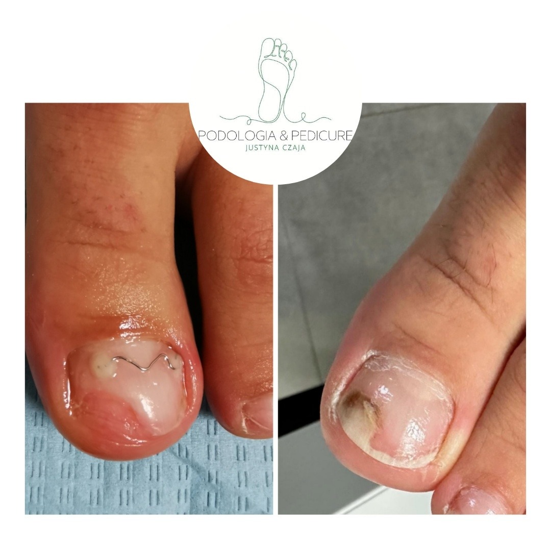 Zdjęcie porównawcze paznokci palucha: po lewej z założonym drutem korygującym wrastający paznokieć, po prawej paznokieć z widoczną zmianą chorobową.