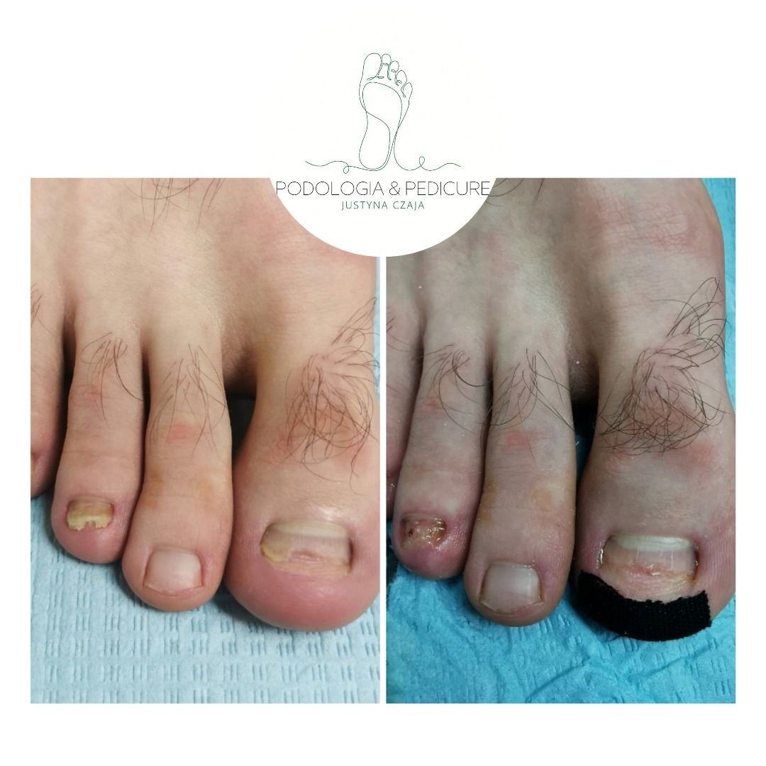 Porównanie stanu stóp przed i po zabiegu podologicznym: uszkodzony paznokieć dużego palca przed i zabezpieczony czarnym plastrem po zabiegu, widoczne zmiany na skórze palców.