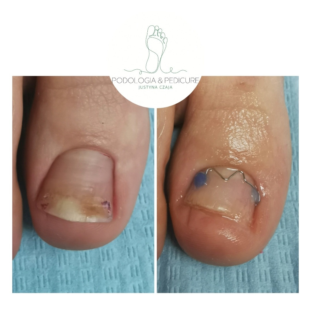 Porównanie paznokcia przed i po założeniu klamry ortonyksyjnej z niebieskimi akcentami na skórze wokół paznokcia, na tle niebieskiej podkładki. Klamra ma na celu korekcję wrastającego paznokcia.