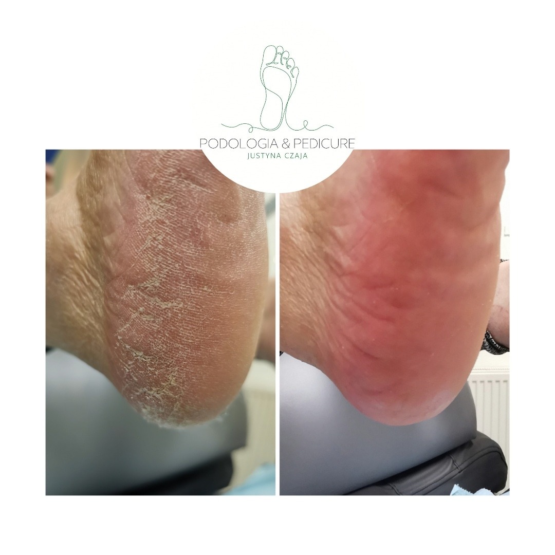 Porównanie pięty przed i po zabiegu: sucha, popękana skóra kontra gładka, nawilżona pięta. Widoczna poprawa kondycji skóry.