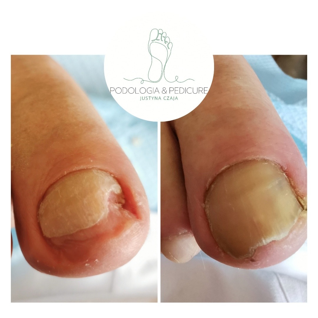 Zdjęcie porównawcze palca stopy przed i po zabiegu podologicznym, widoczna poprawa stanu paznokcia i skóry wokół niego, w tle logo firmy.