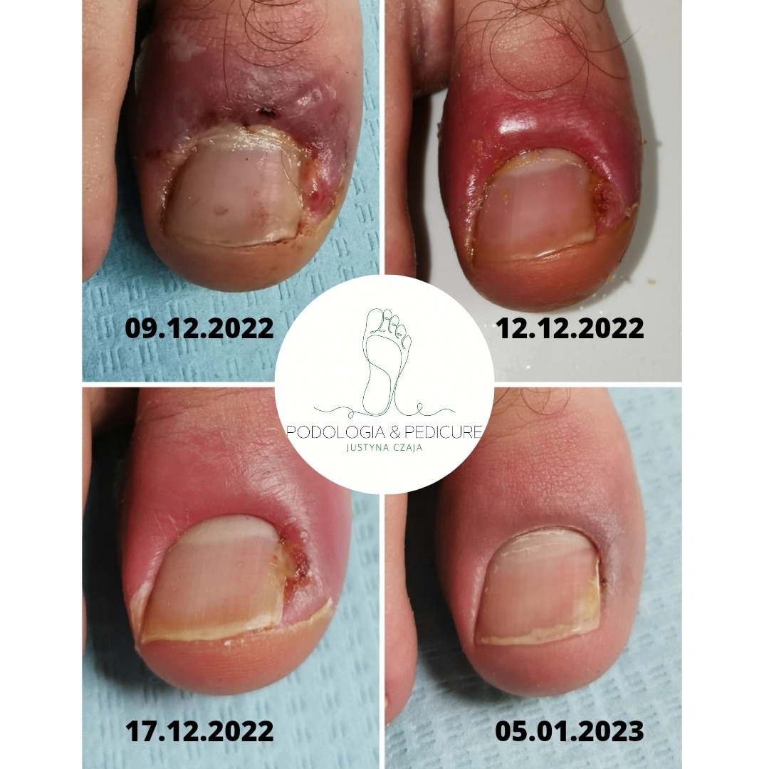 Cztery zdjęcia palucha z wrastającym paznokciem, ukazujące postęp leczenia w czasie, od stanu zapalnego do poprawy, z datami 09.12.2022, 12.12.2022, 17.12.2022 i 05.01.2023, na tle logo gabinetu...