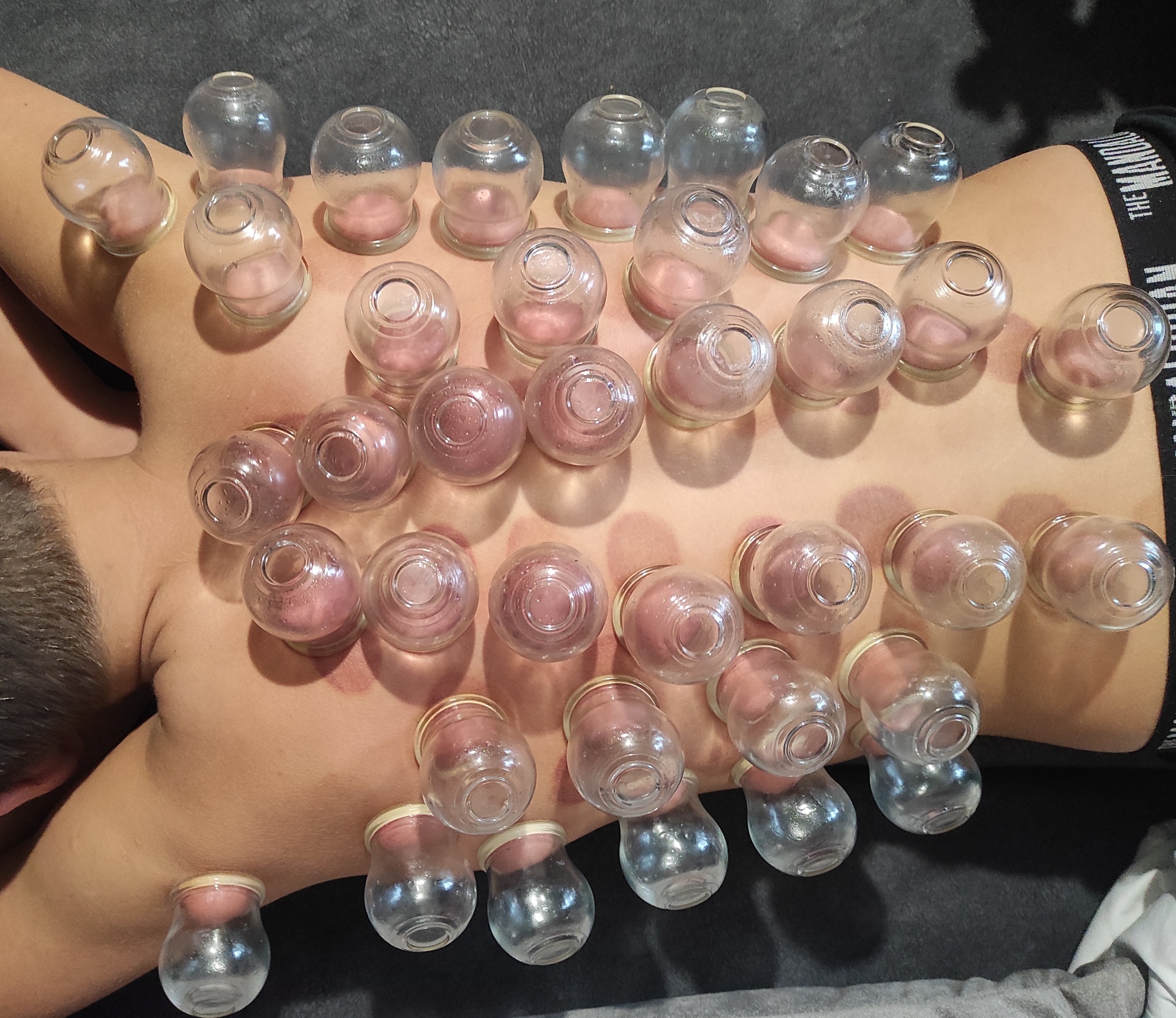 Plecy mężczyzny z licznymi szklanymi bańkami, widoczne zaczerwienienia skóry po zabiegu.