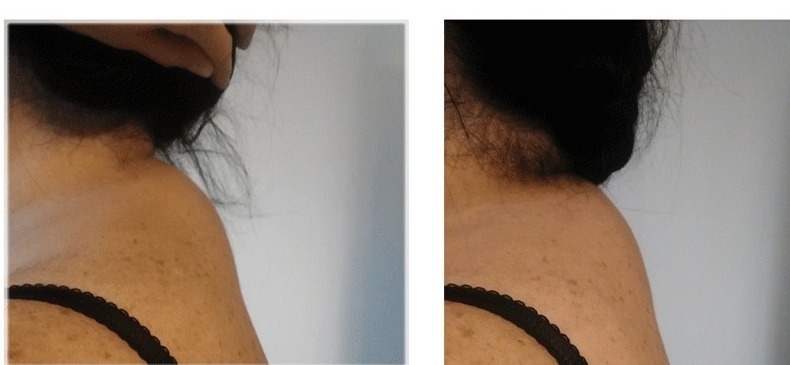 Fragment ciała kobiety, obejmujący szyję i ramię, z widocznymi piegami i czarnym ramiączkiem biustonosza, sfotografowany na tle jasnej ściany.