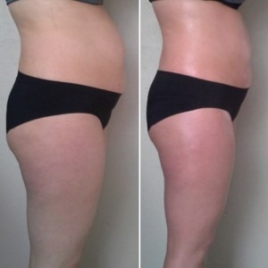 Porównanie sylwetki kobiety przed i po zabiegu, widoczne zmiany w jędrności skóry i redukcji obwodu talii.