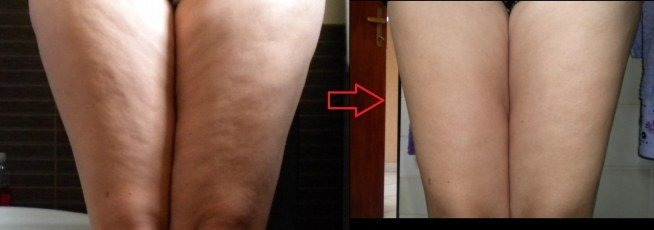 Porównanie ud przed i po zabiegu redukcji cellulitu, widoczne zmiany w strukturze skóry po prawej stronie, strzałka wskazująca na poprawę.