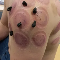 Plecy pacjenta z widocznymi śladami po bańkach i pijawkami lekarskimi w trakcie zabiegu hirudoterapii.