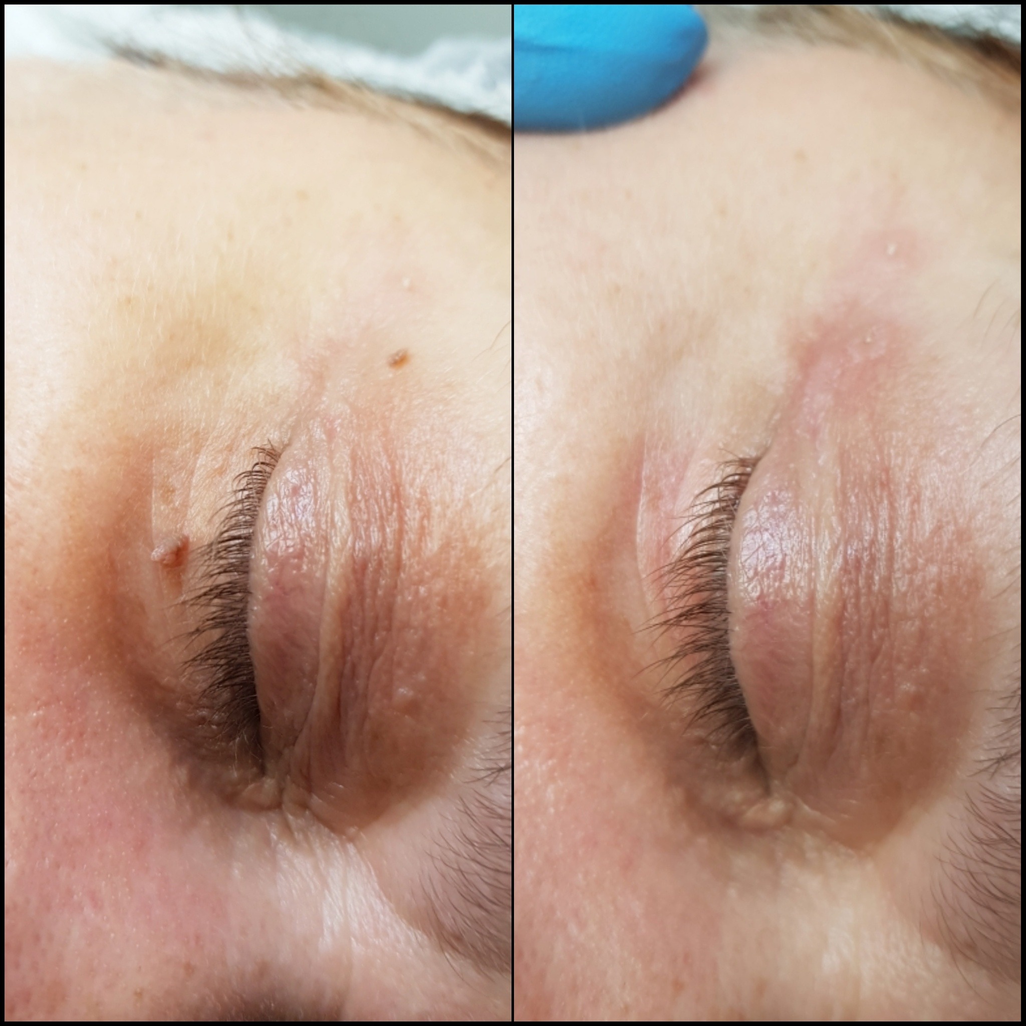 Zbliżenie na skórę wokół oka przed i po usunięciu zmiany skórnej, widoczny efekt zabiegu.