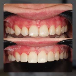 STOMO Indywidualna Praktyka Lekarska Anna Duda - Zdjęcie przedstawia górne i dolne zęby pacjenta przed i po zabiegu, z widocznymi poprawkami estetycznymi w postaci jaśniejszego koloru i wyrównanego kształtu zębów przednich. Na dolnym zdjęciu...
