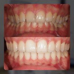 STOMO Indywidualna Praktyka Lekarska Anna Duda - Zdjęcie porównawcze zębów przed i po zabiegu korekty zgryzu, widoczne zmiany w ustawieniu i kształcie zębów.