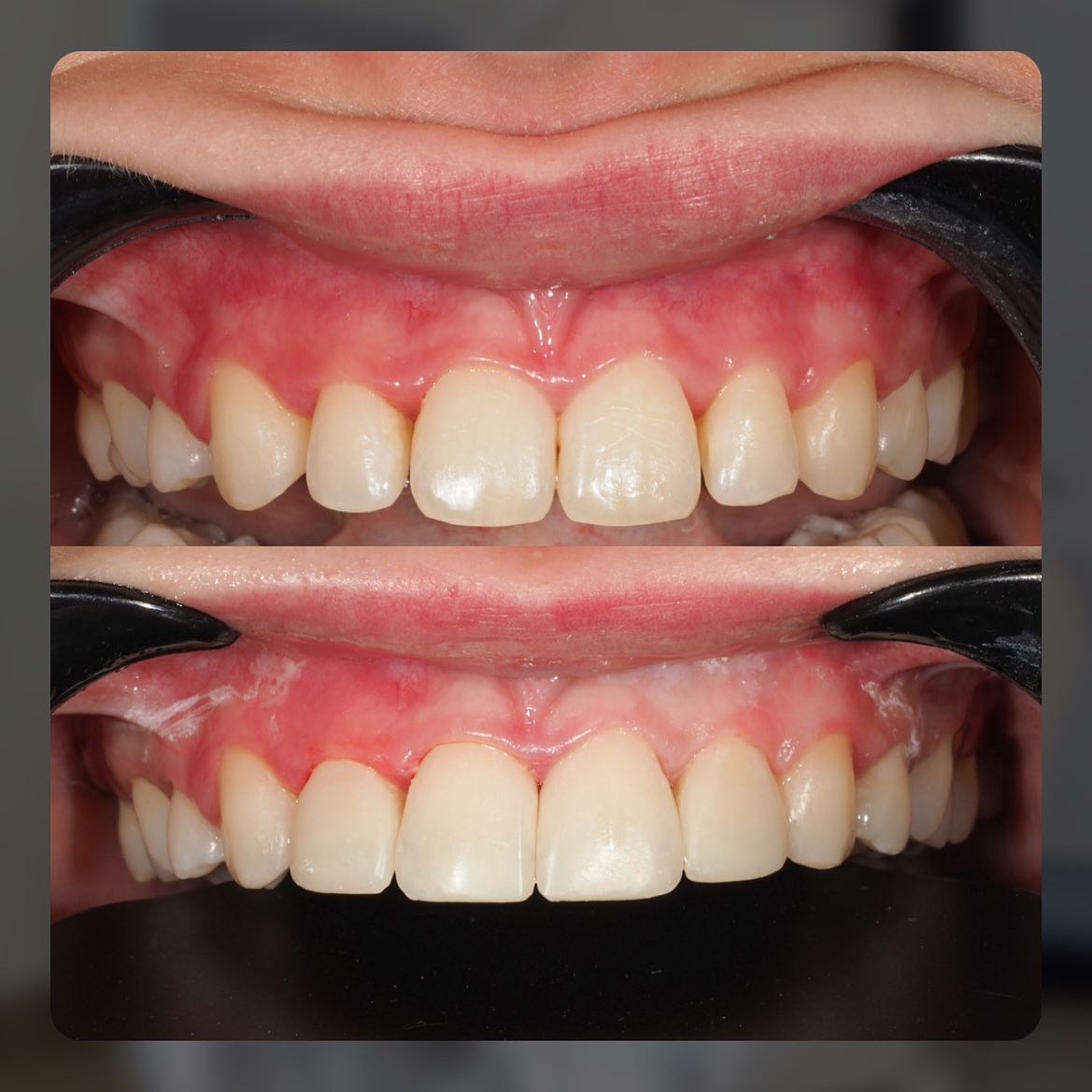 Zdjęcie przedstawia górne i dolne zęby pacjenta przed i po zabiegu, z widocznymi poprawkami estetycznymi w postaci jaśniejszego koloru i wyrównanego kształtu zębów przednich. Na dolnym zdjęciu...