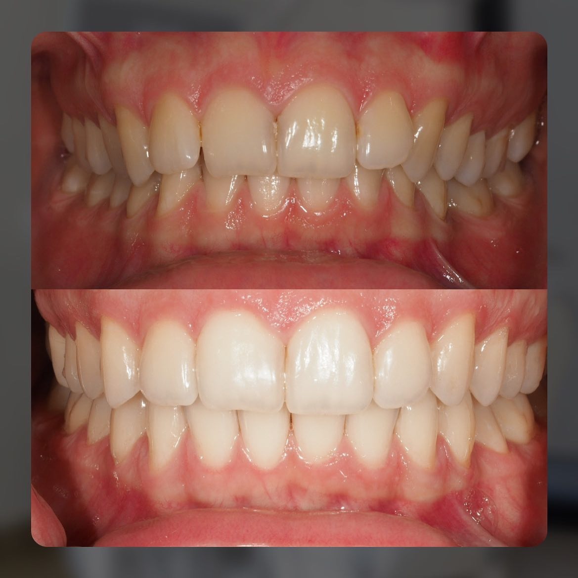 Zdjęcie porównawcze zębów przed i po zabiegu korekty zgryzu, widoczne zmiany w ustawieniu i kształcie zębów.