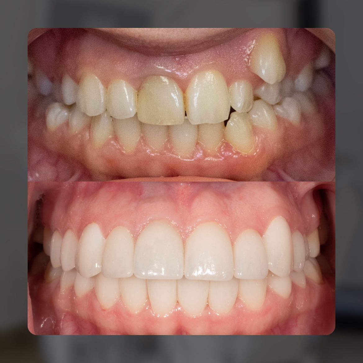 Zdjęcie 'przed i po' przedstawiające korektę zgryzu i wybielanie zębów, widoczne nierówności i przebarwienia na górnym zdjęciu w kontraście do idealnie wyrównanego i jasnego uśmiechu na dolnym...
