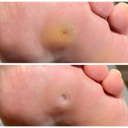 Tajemnice Urody Paulina Kwasiborska - Zbliżenie na podeszwę stopy przed i po usunięciu odcisku; widoczne różnice w wyglądzie skóry i strukturze odcisku.