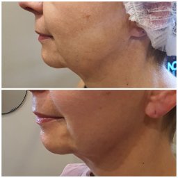 Tajemnice Urody Paulina Kwasiborska - Porównanie profilu twarzy i szyi kobiety przed i po zabiegu, widoczne napięcie skóry podbródka.