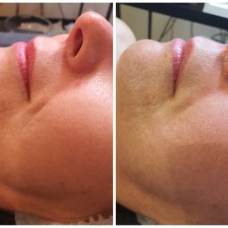 Tajemnice Urody Paulina Kwasiborska - Zbliżenie na profil twarzy kobiety przed i po zabiegu, widoczna poprawa napięcia skóry i redukcja zmarszczek w okolicy policzków, usta lekko pomalowane błyszczykiem.