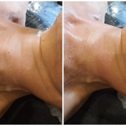 Tajemnice Urody Paulina Kwasiborska - Zdjęcie szyi kobiety przed i po zabiegu, widoczne zaczerwienienia i drobne zmiany skórne, porównanie efektu.