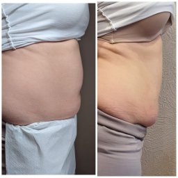 Tajemnice Urody Paulina Kwasiborska - Porównanie sylwetki brzucha przed i po zabiegu, widoczne zmniejszenie obwodu i poprawa napięcia skóry na zdjęciu po prawej stronie.