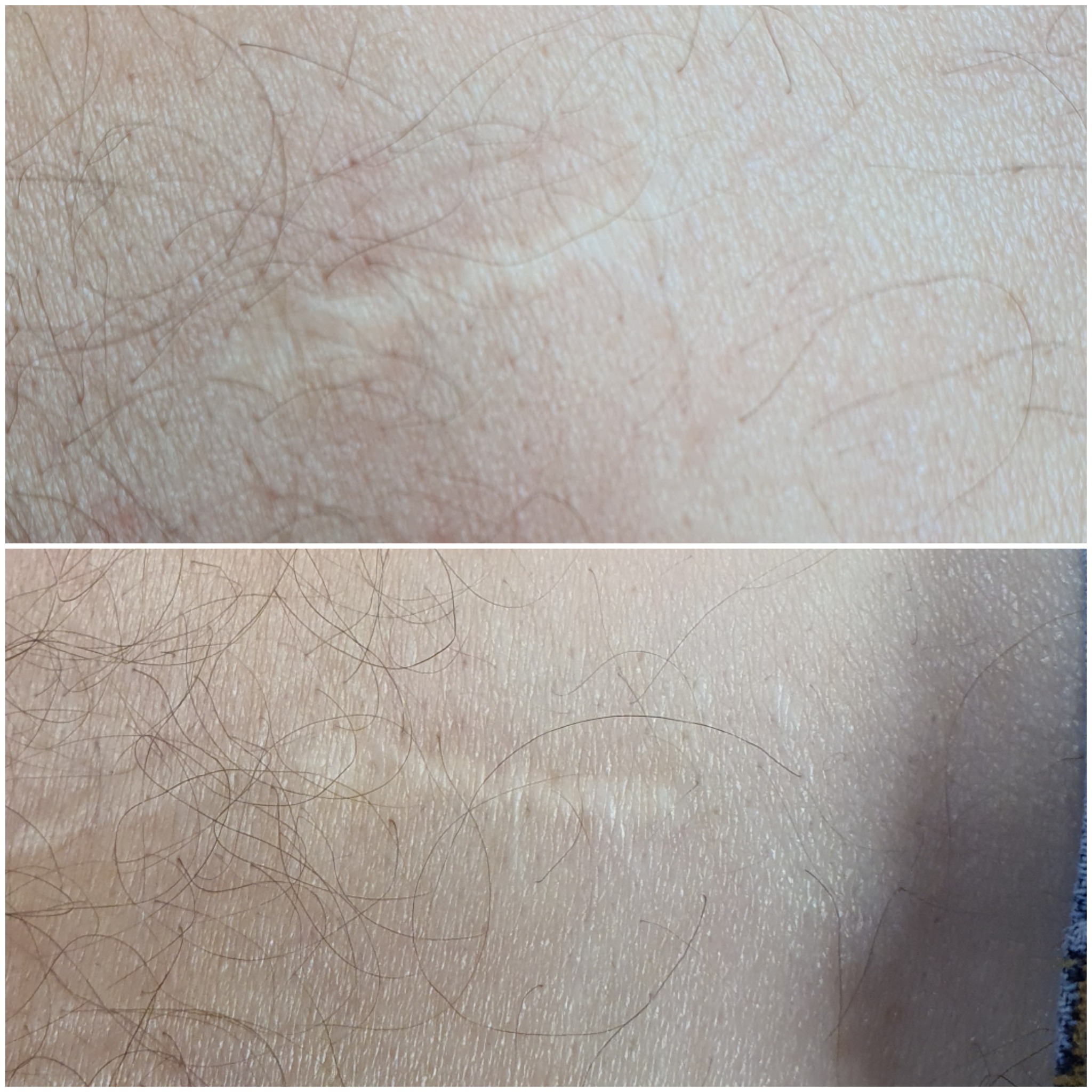 Zbliżenie skóry z widoczną blizną przed i po zabiegu, ukazujące efekt wizualny.