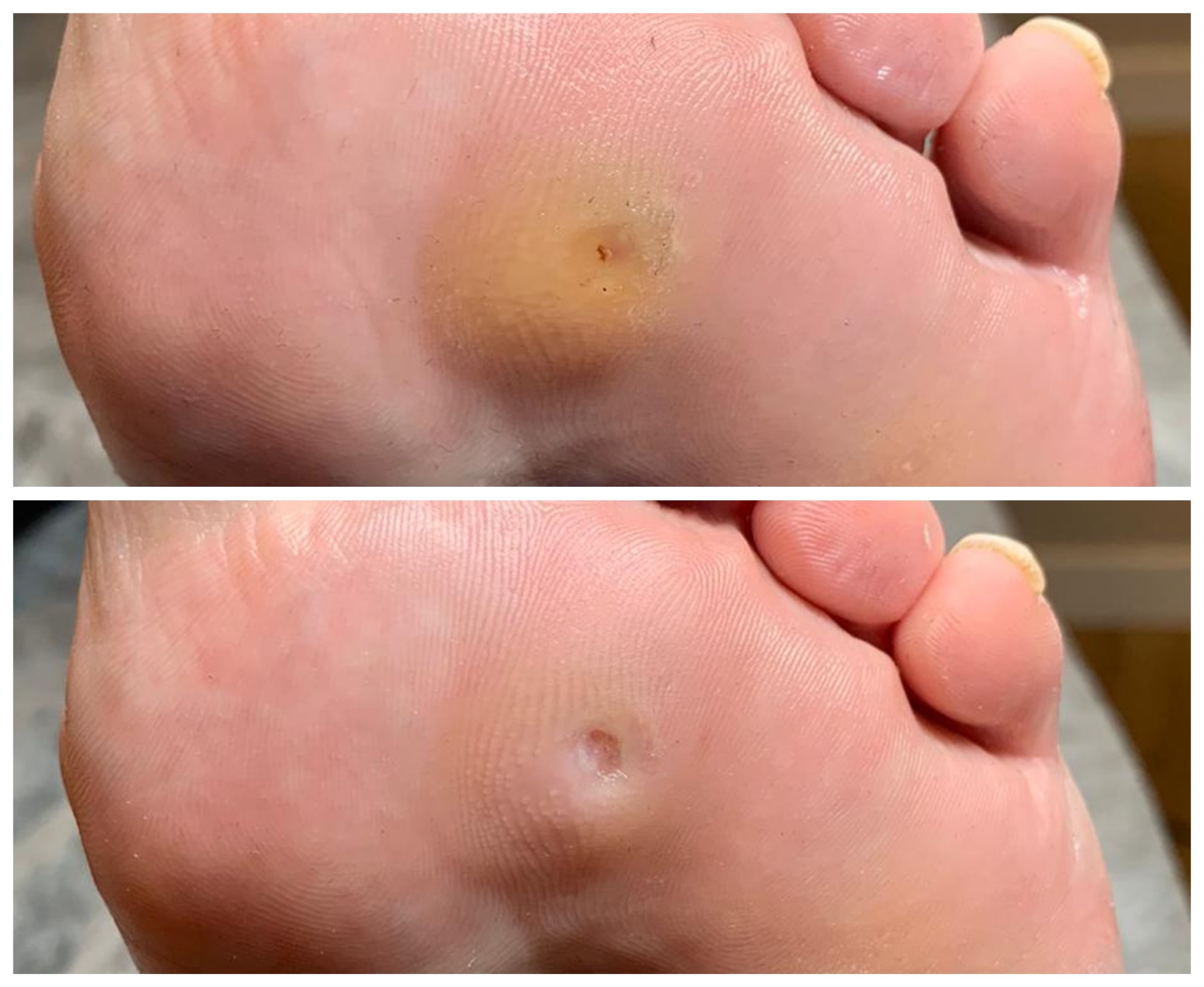 Zbliżenie na podeszwę stopy przed i po usunięciu odcisku; widoczne różnice w wyglądzie skóry i strukturze odcisku.