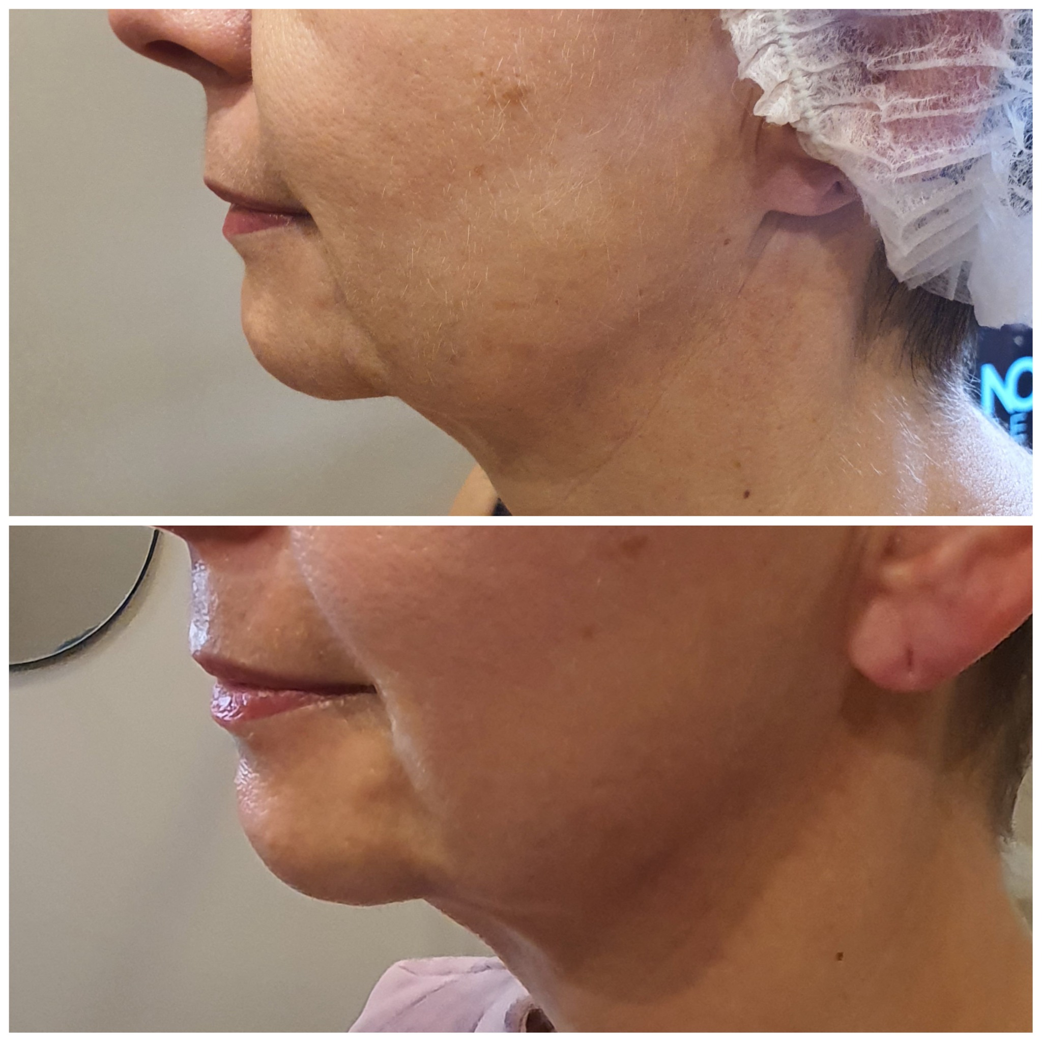 Porównanie profilu twarzy i szyi kobiety przed i po zabiegu, widoczne napięcie skóry podbródka.