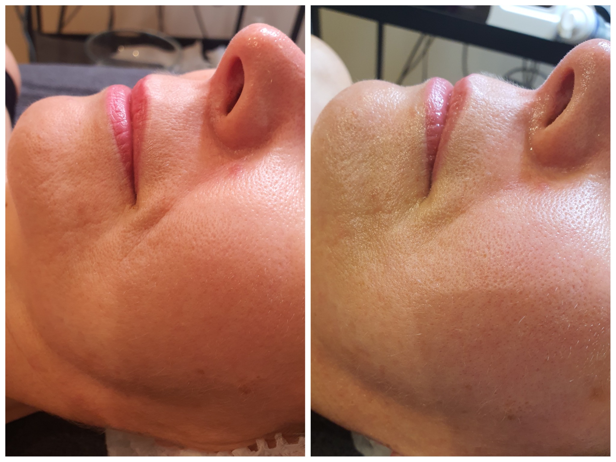 Zbliżenie na profil twarzy kobiety przed i po zabiegu, widoczna poprawa napięcia skóry i redukcja zmarszczek w okolicy policzków, usta lekko pomalowane błyszczykiem.