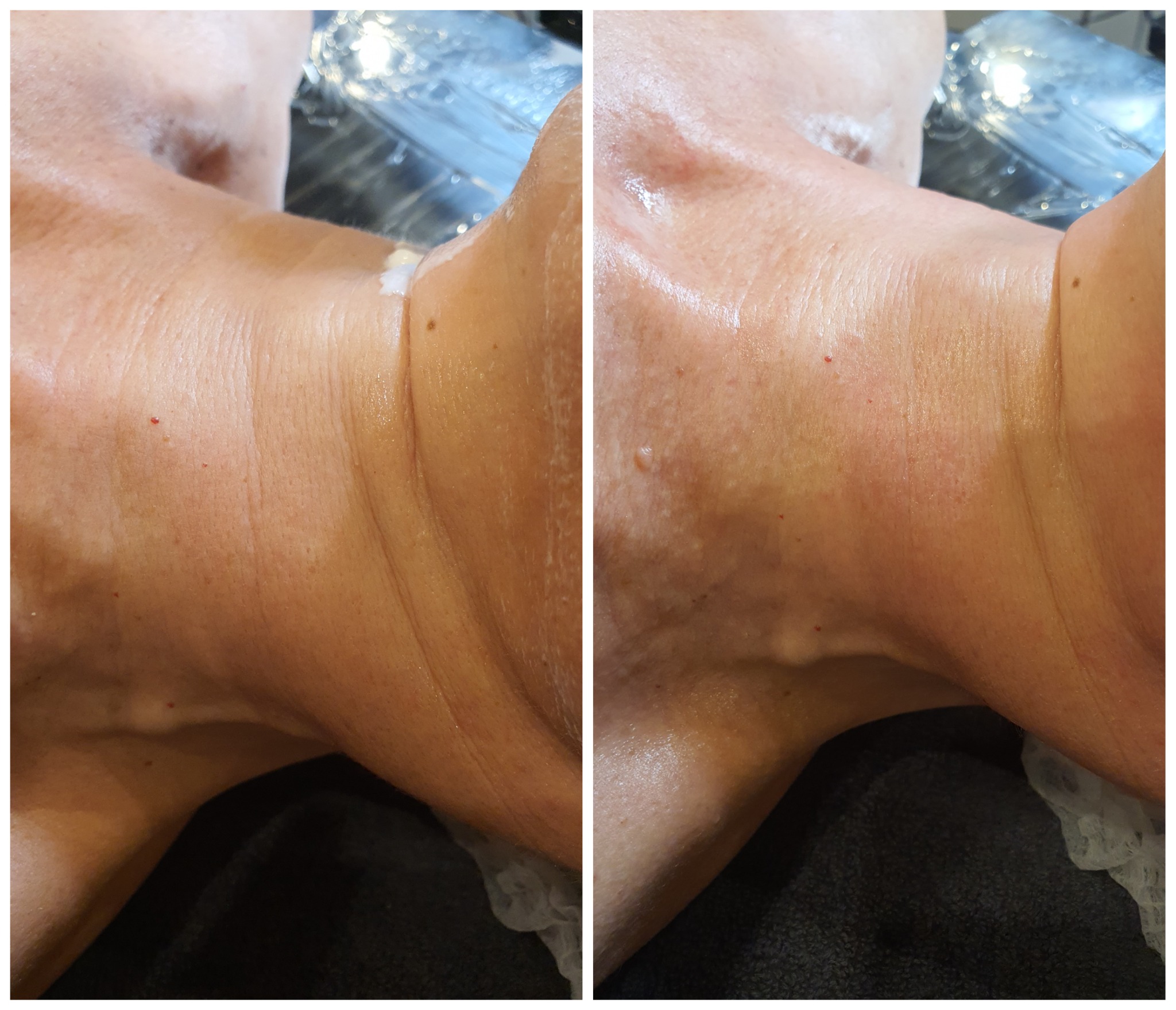 Zdjęcie szyi kobiety przed i po zabiegu, widoczne zaczerwienienia i drobne zmiany skórne, porównanie efektu.