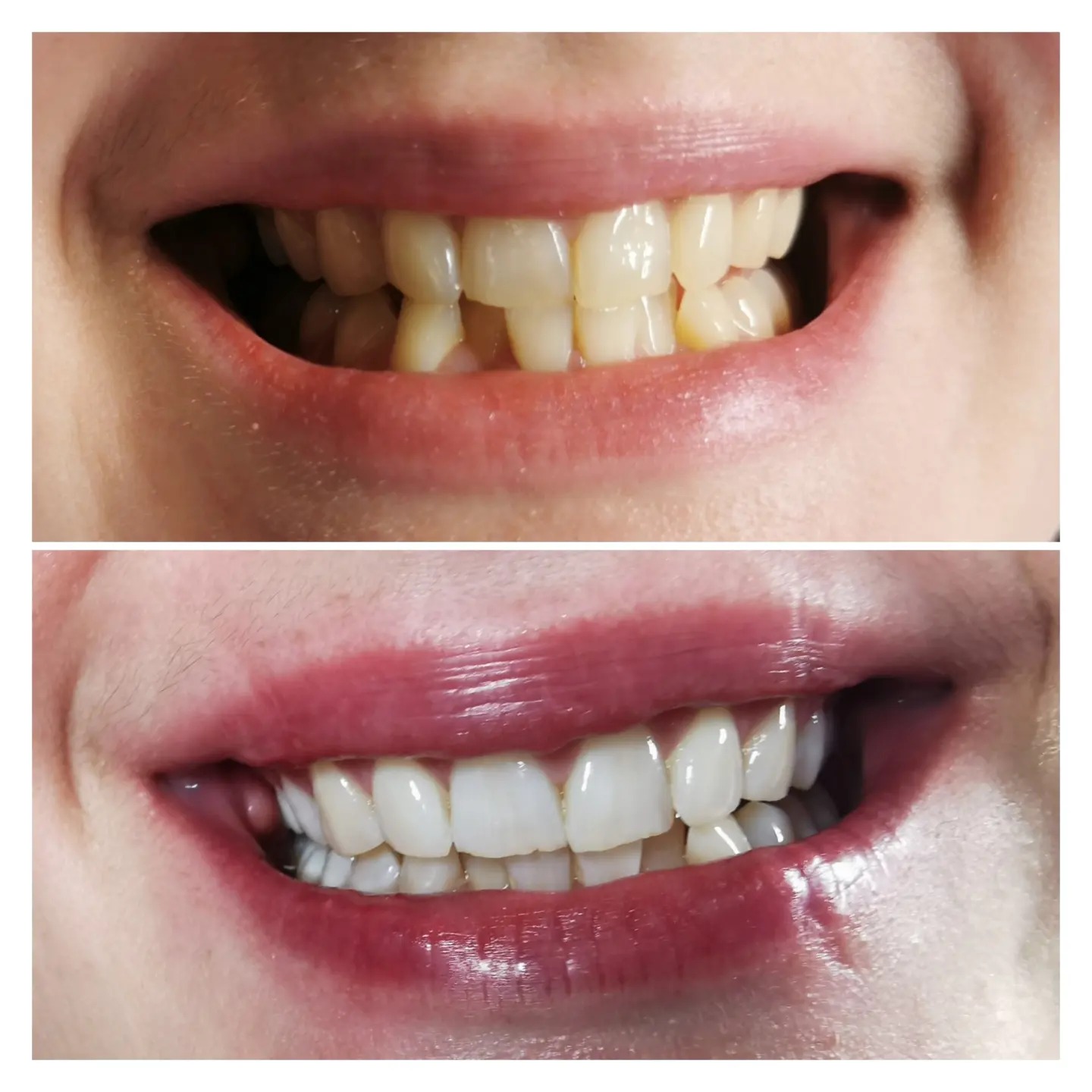 Zdjęcie typu 'przed i po' przedstawia uśmiech. Górna część pokazuje zęby o żółtawym odcieniu, dolna część prezentuje wybielone, białe zęby z nałożoną błyszczącą pomadką w odcieniu ciemnej czerwieni.