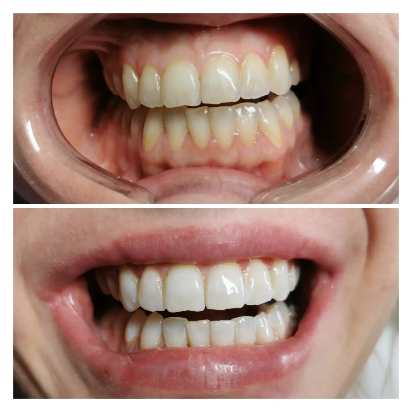 Zdjęcie typu 'przed i po' przedstawiające zęby: górny kadr pokazuje zęby z widocznym żółtym nalotem, rozwarte przez plastikowy ekspander, a dolny kadr prezentuje ten sam uśmiech po zabiegu,...