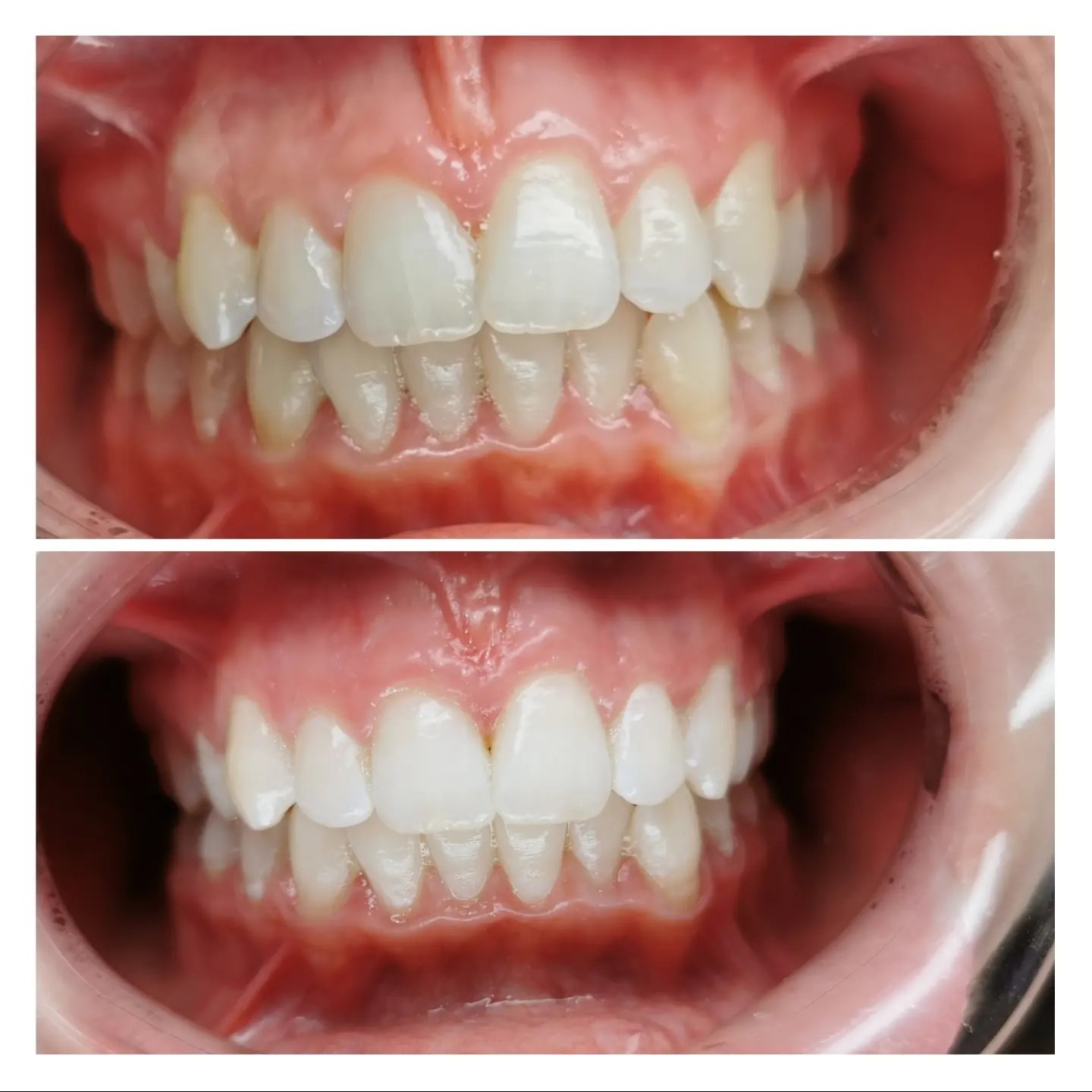 Zbliżenie na zęby przed i po zabiegu wybielania, widoczne różnice w odcieniu i połysku, ujęcie od wewnątrz jamy ustnej.