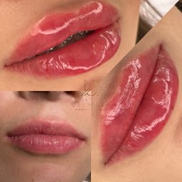 Powiększanie ust metodą na płasko BABY DOLL