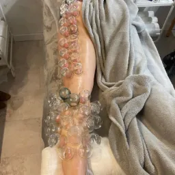 Noga pacjenta z licznymi szklanymi bańkami przyssawkami do skóry, ułożona na stole zabiegowym przykrytym szarym kocem.