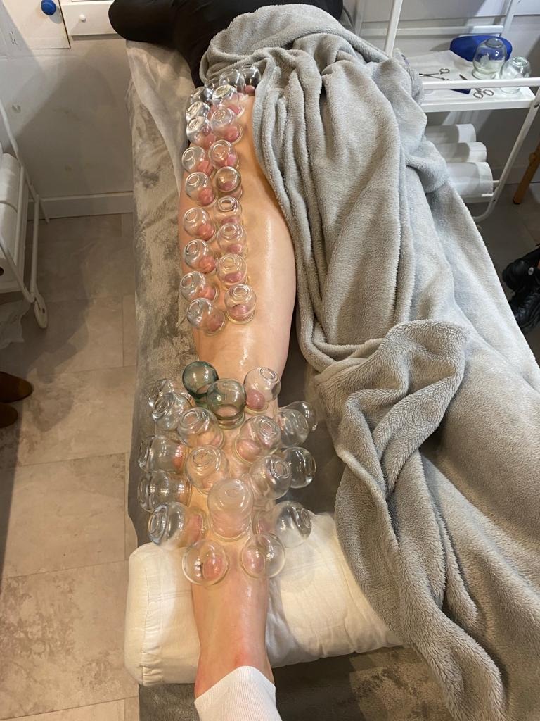 Noga pacjenta z licznymi szklanymi bańkami przyssawkami do skóry, ułożona na stole zabiegowym przykrytym szarym kocem.