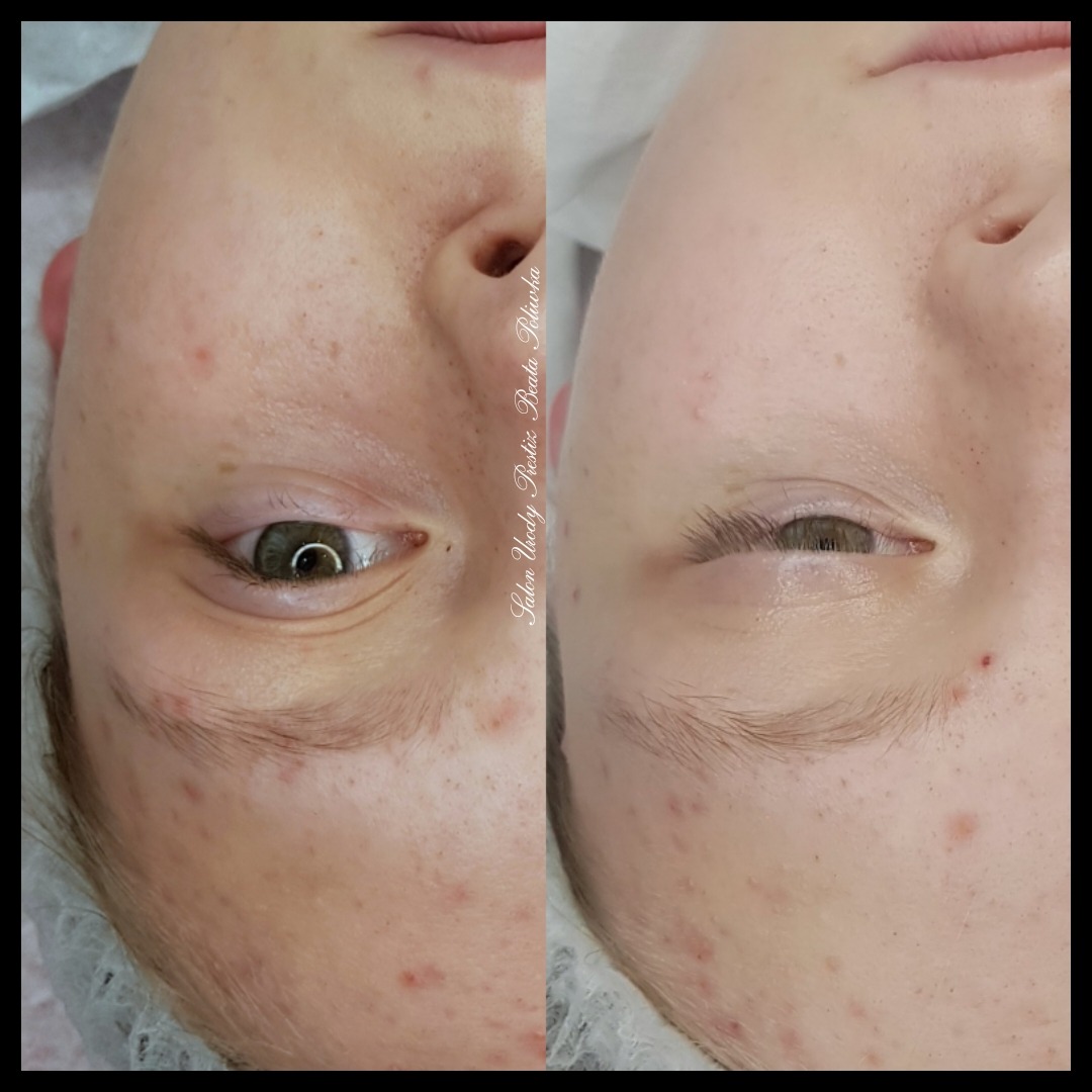 Zbliżenie na twarz przed i po zabiegu na jednym zdjęciu: po lewej stronie widoczna skóra z niedoskonałościami, po prawej stronie skóra po zabiegu, jaśniejsza i bardziej gładka, z widocznym efektem...