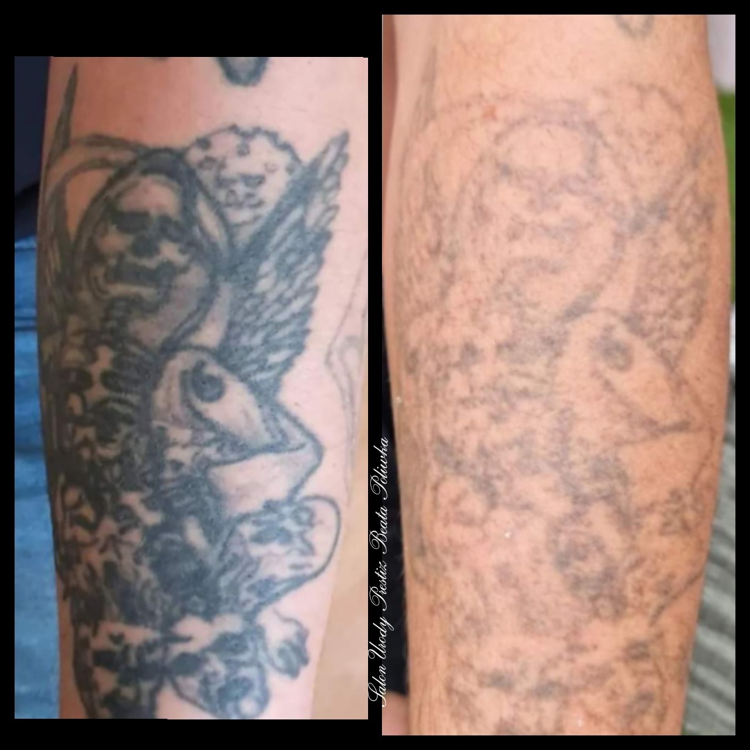 Ramię przed i po zabiegu usuwania tatuażu: po lewej stronie widoczny ciemny tatuaż ze skrzydlatą postacią, po prawej stronie skóra z ledwo widocznym, rozmywającym się wzorem po zabiegu.