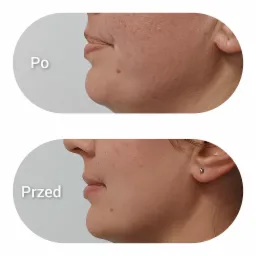 Porównanie 'przed' i 'po' zabiegu redukcji podbródka, widoczne zmiany w profilu twarzy i napięciu skóry.