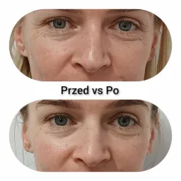 Zbliżenie na twarz kobiety, porównanie stanu skóry wokół oczu przed i po zabiegu, widoczna redukcja zmarszczek.