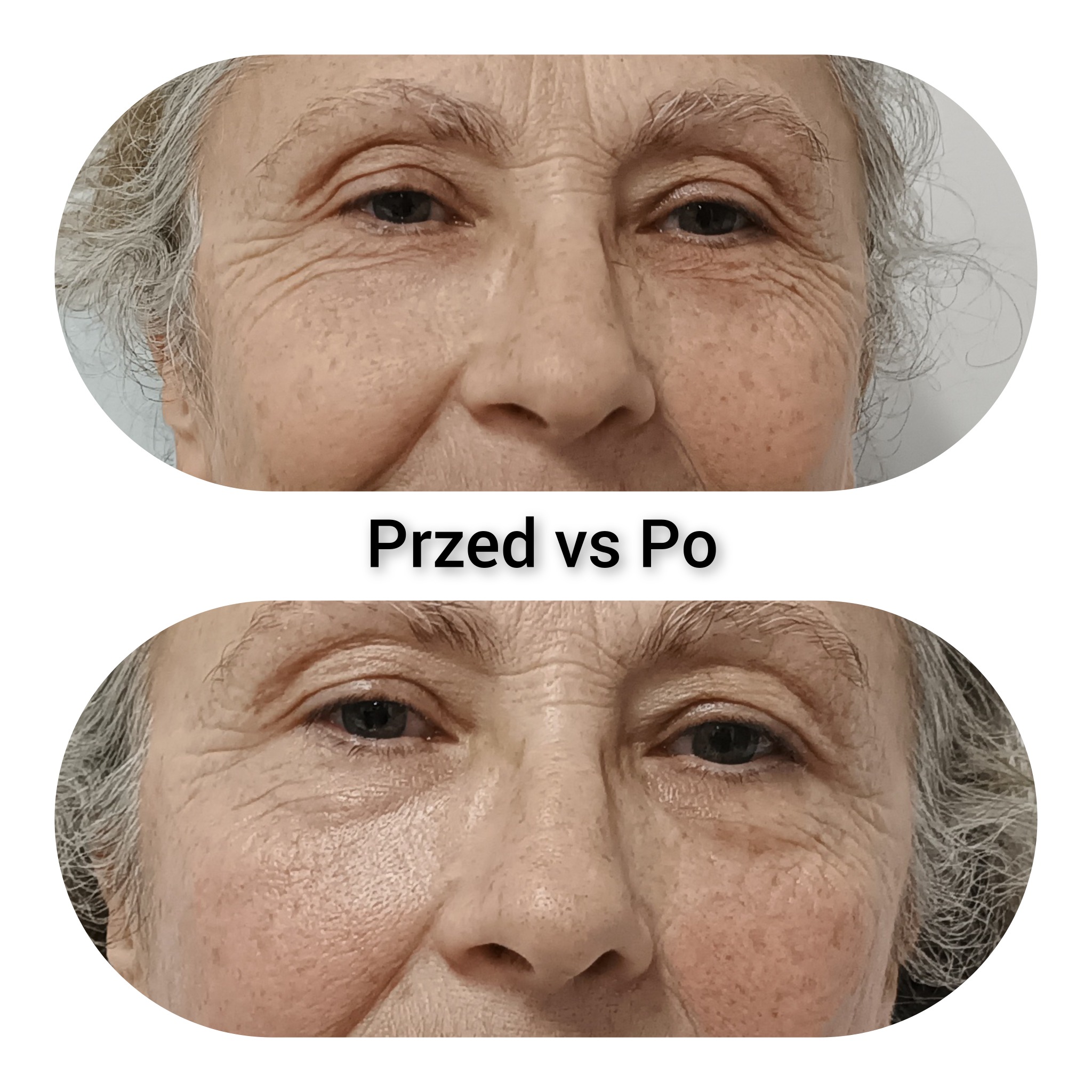 Zbliżenie na twarz starszej kobiety, porównanie stanu skóry wokół oczu przed i po zabiegu, widoczne zmarszczki i poprawa elastyczności skóry.