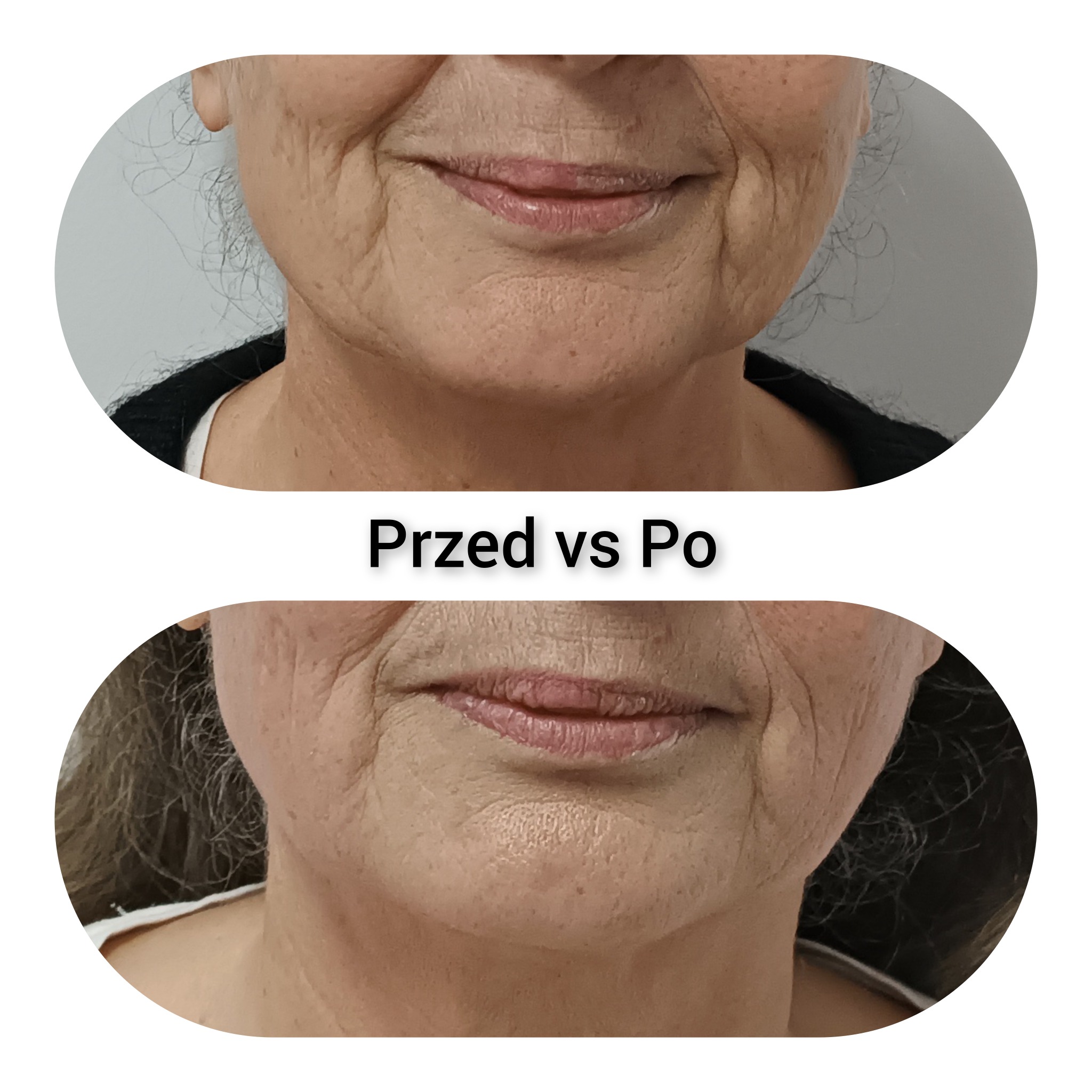Zbliżenie na twarz kobiety, ukazujące porównanie stanu skóry przed i po zabiegu, z widoczną redukcją zmarszczek i poprawą napięcia skóry.