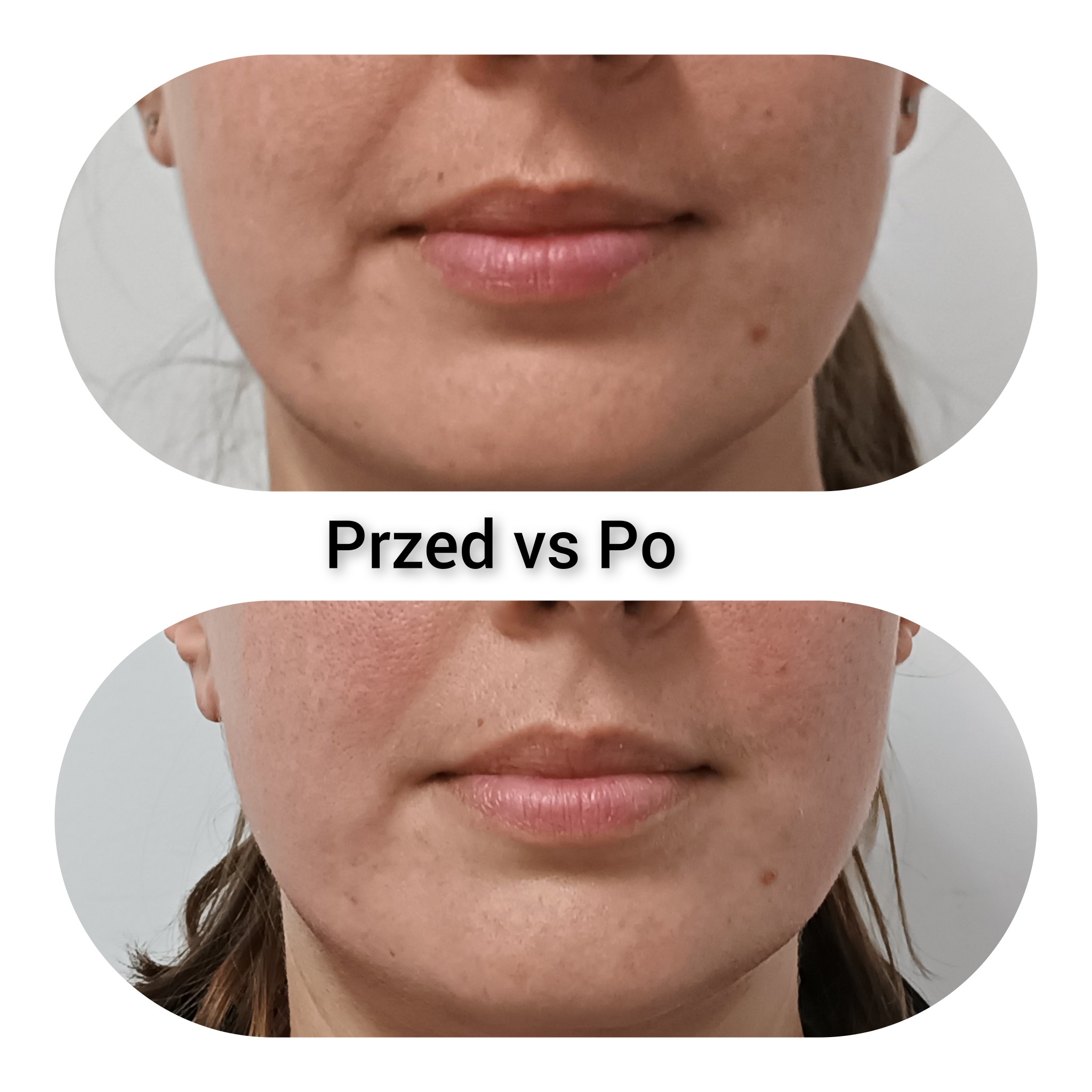 Zdjęcie 'Przed vs Po' przedstawiające dolną część twarzy kobiety, z widoczną różnicą w napięciu skóry i kształcie ust po zabiegu.