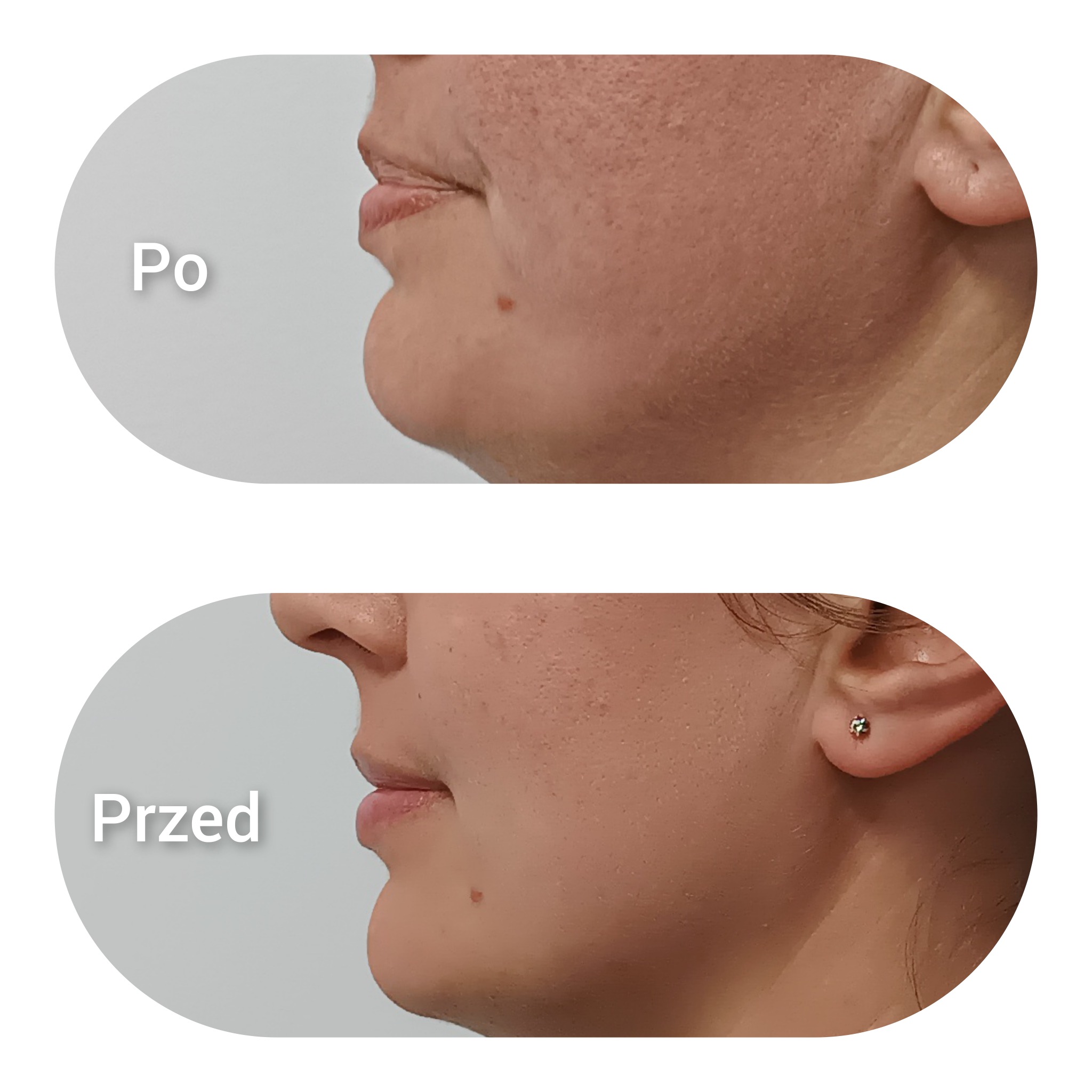 Porównanie 'przed' i 'po' zabiegu redukcji podbródka, widoczne zmiany w profilu twarzy i napięciu skóry.