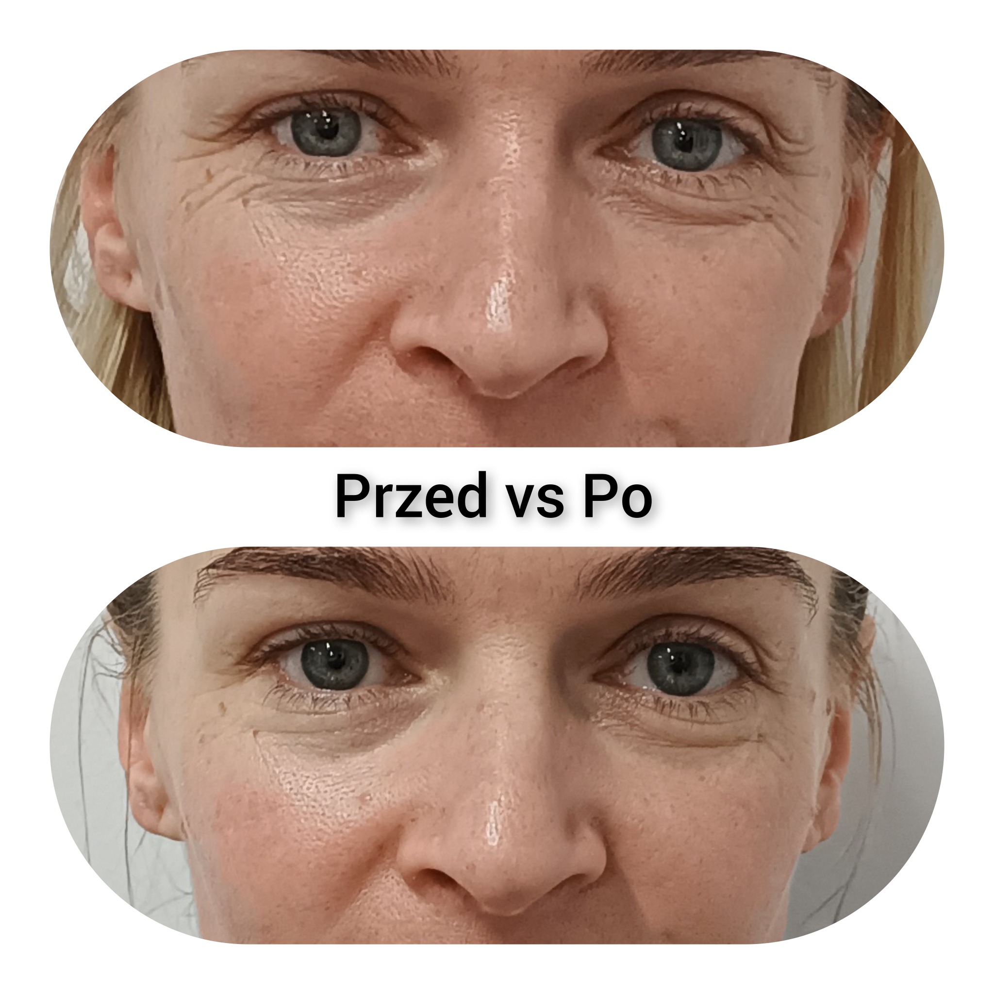 Zbliżenie na twarz kobiety, porównanie stanu skóry wokół oczu przed i po zabiegu, widoczna redukcja zmarszczek.