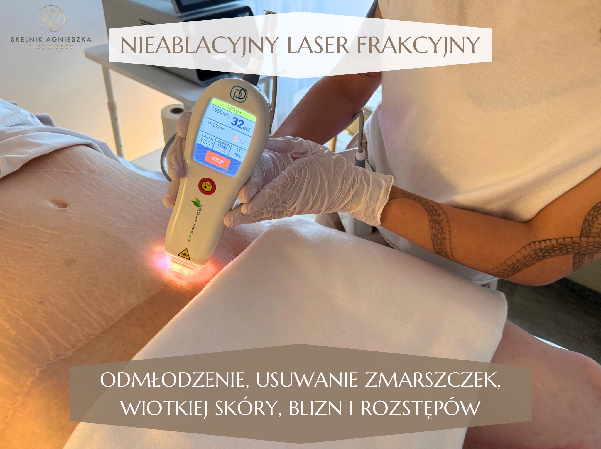Laser frakcyjny nieablacyjny w trakcie zabiegu na brzuchu pacjenta. Widoczny aparat z wyświetlaczem, rękawice ochronne i tatuaż na ramieniu osoby wykonującej zabieg.