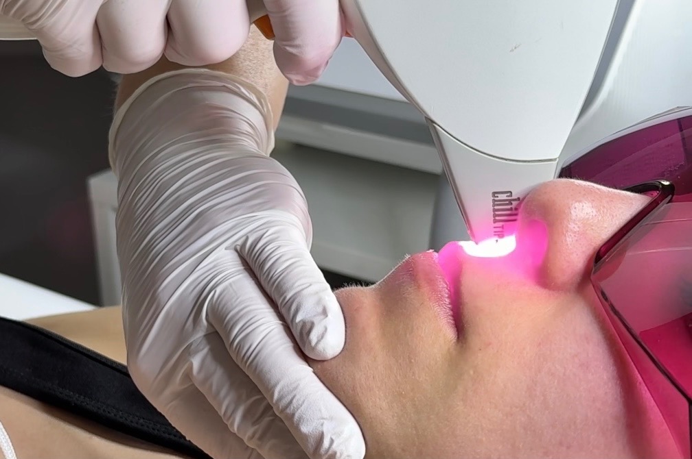 Z bliska: laser diodowy precyzyjnie usuwa owłosienie nad górną wargą pacjentki, chronionej okularami. Rękawice ochronne zapewniają higienę.