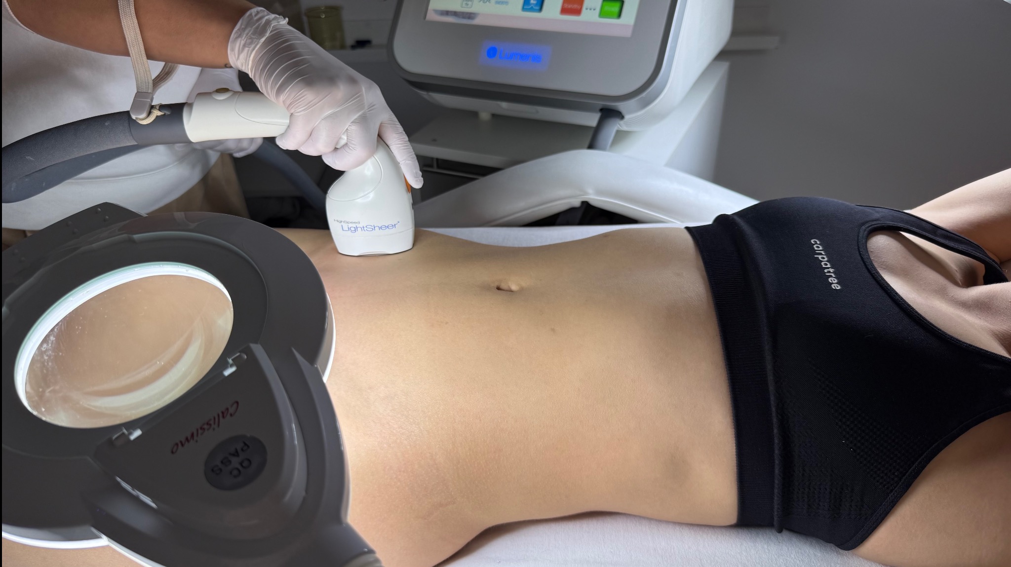 Zabieg depilacji laserowej na brzuchu pacjentki, wykonywany przez osobę w rękawiczkach, z użyciem urządzenia LightSheer i lampy powiększającej Calissimo.